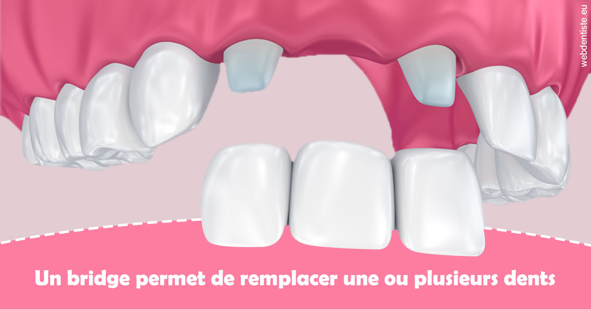 https://www.dr-thierry-jasion.fr/Bridge remplacer dents 2