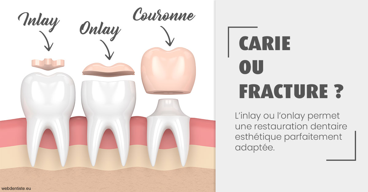 https://www.dr-thierry-jasion.fr/T2 2023 - Carie ou fracture 1