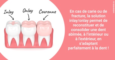 https://www.dr-thierry-jasion.fr/L'INLAY ou l'ONLAY 2