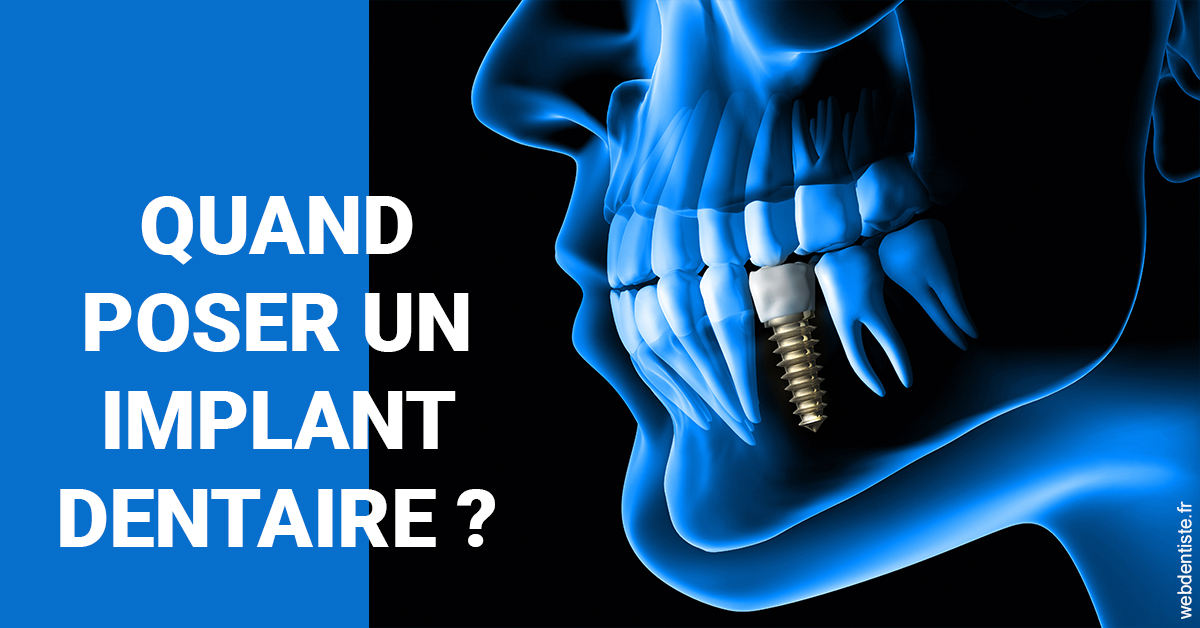 https://www.dr-thierry-jasion.fr/Les implants 1