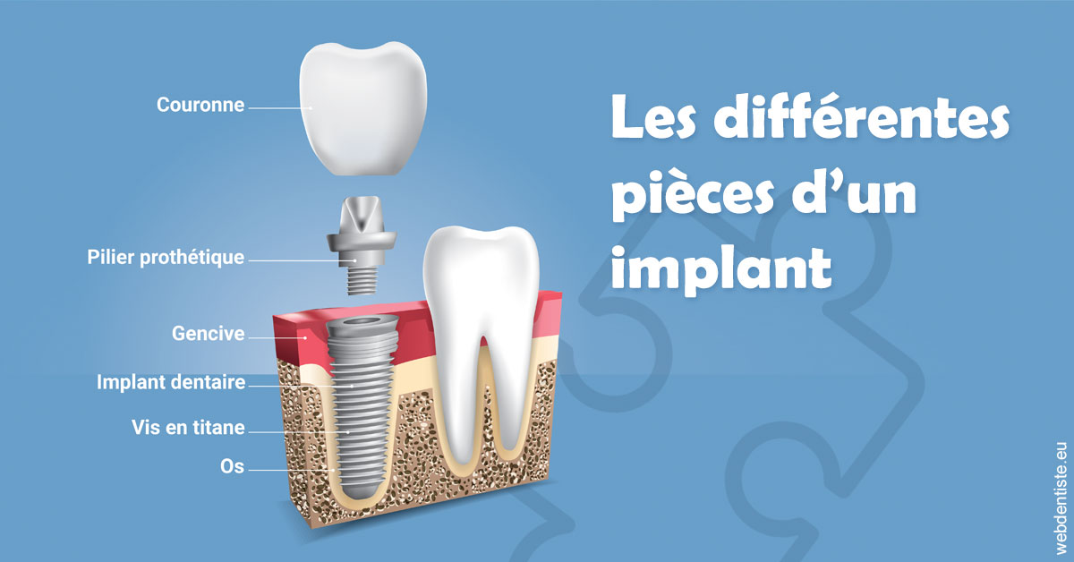 https://www.dr-thierry-jasion.fr/Les différentes pièces d’un implant 1